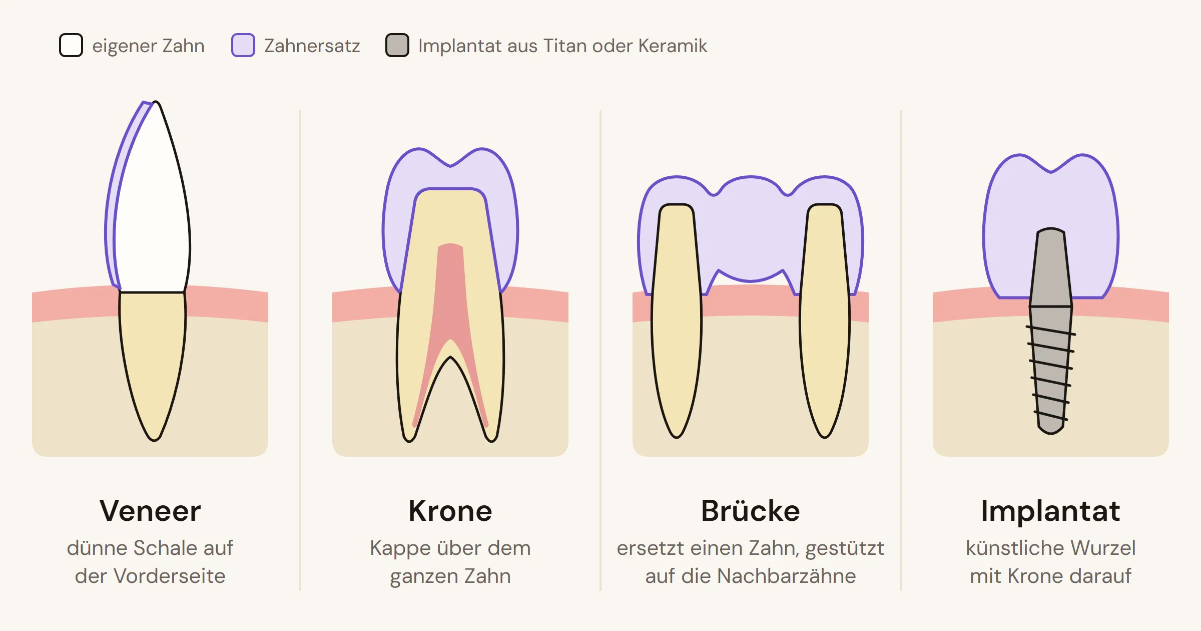 Vier Zeichnungen im Vergleich: Veneer als dünne Schale auf der Vorderseite, Krone als Kappe über dem ganzen Zahn, Brücke auf den Nachbarzähnen und Implantat mit Krone.